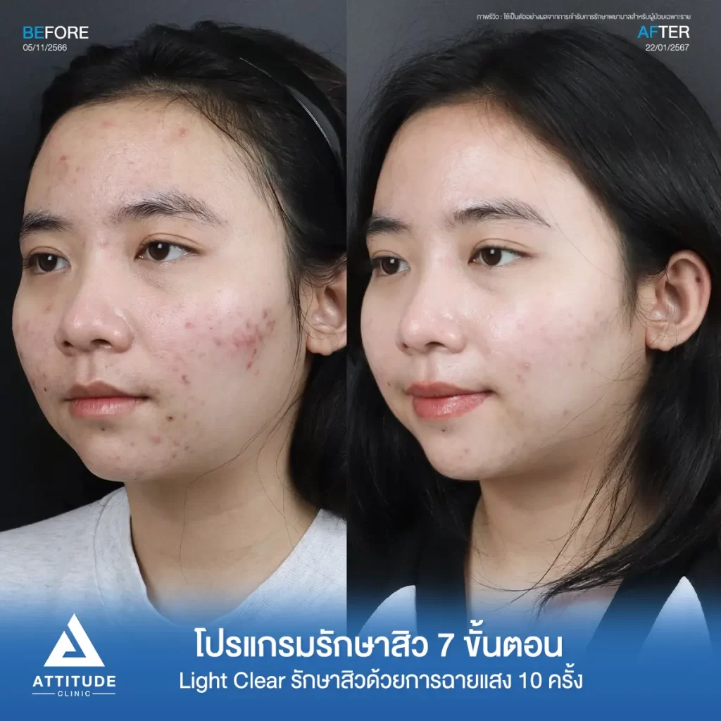 รีวิวรักษาสิวคุณไอซ์ ด้วยการฉายแสง โปรแกรมรักษาสิว Light Clear 7 ขั้นตอน จำนวน 10 ครั้ง รักษาสิวอักเสบ สิวอุดตัน และรอยแดงสิวทั่วใบหน้าที่ Attitude Clinic