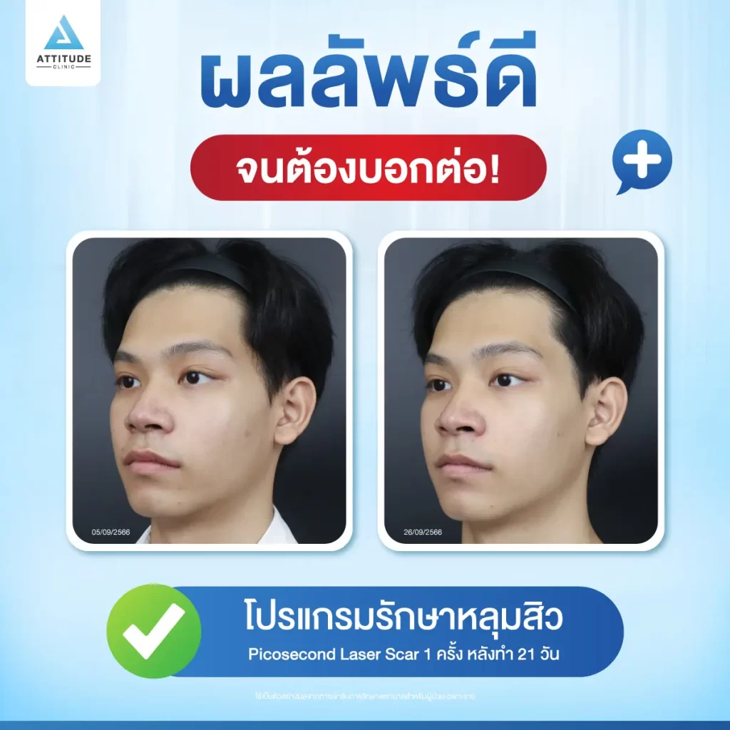 รักษาหลุมสิว ขอยกให้โปรแกรม Picosecond Laser รักษาครอบคลุมปัญหาผิว กระตุ้นสร้างคอลลาเจนใหม่ ให้ผิวเรียบเนียน หลุมสิวตื้นขึ้นด้วยการสร้าง LIOB ฟองอากาศลูกโป่งใต้ผิว