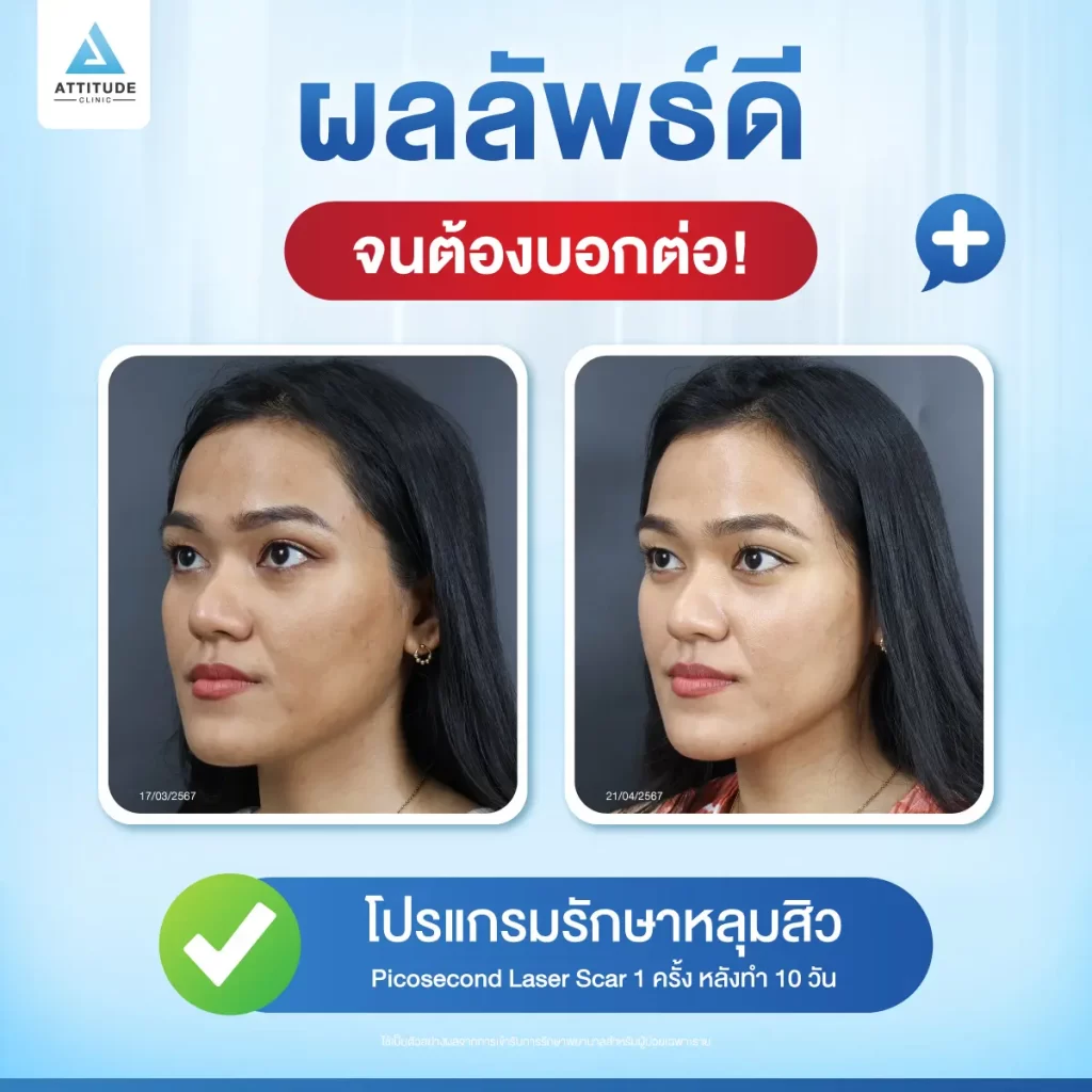 รักษาหลุมสิว ขอยกให้โปรแกรม Picosecond Laser รักษาครอบคลุมปัญหาผิว กระตุ้นสร้างคอลลาเจนใหม่ ให้ผิวเรียบเนียน หลุมสิวตื้นขึ้นด้วยการสร้าง LIOB ฟองอากาศลูกโป่งใต้ผิว