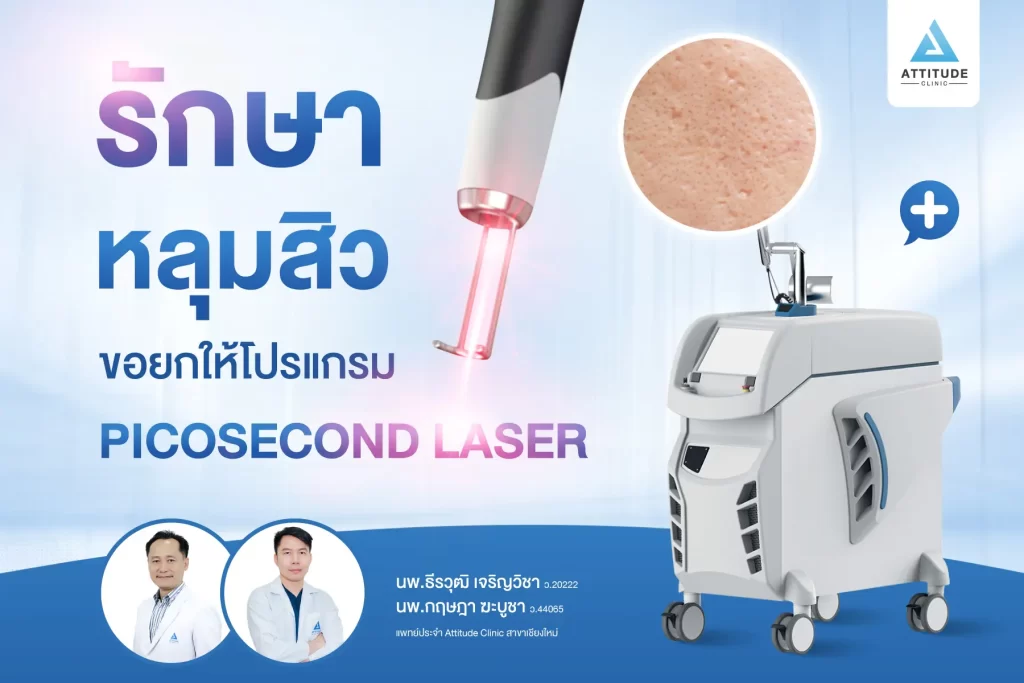 รักษาหลุมสิว ขอยกให้โปรแกรม Picosecond Laser รักษาครอบคลุมปัญหาผิว กระตุ้นสร้างคอลลาเจนใหม่ ให้ผิวเรียบเนียน หลุมสิวตื้นขึ้นด้วยการสร้าง LIOB ฟองอากาศลูกโป่งใต้ผิว