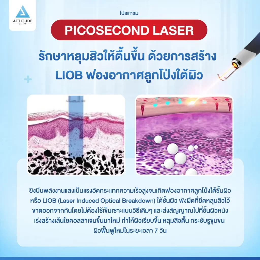 รักษาหลุมสิว ขอยกให้โปรแกรม Picosecond Laser รักษาครอบคลุมปัญหาผิว กระตุ้นสร้างคอลลาเจนใหม่ ให้ผิวเรียบเนียน หลุมสิวตื้นขึ้นด้วยการสร้าง LIOB ฟองอากาศลูกโป่งใต้ผิว