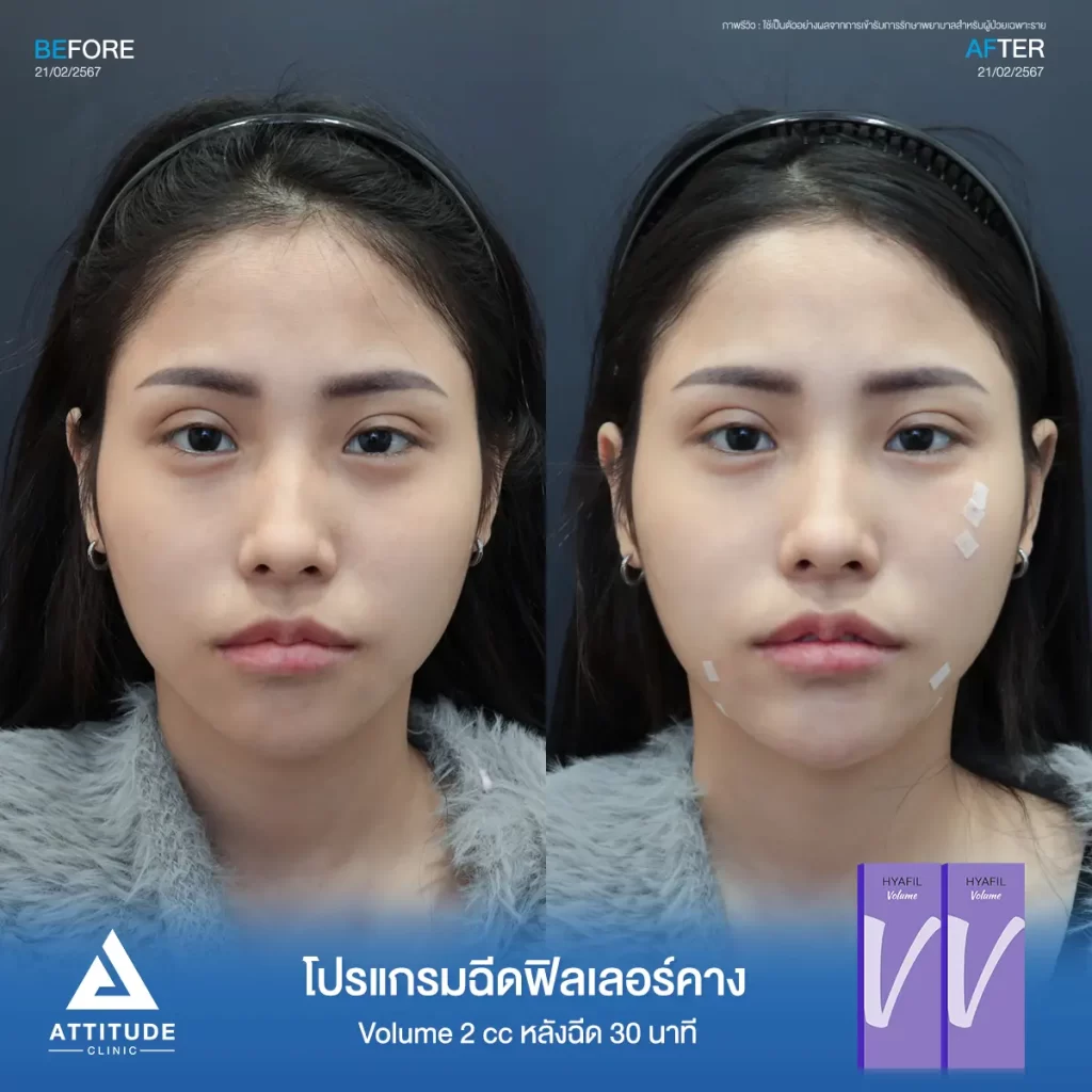 รีวิวโปรแกรมฉีดฟิลเลอร์คางคุณพิม รุ่น Volume จำนวน 2 cc หลังฉีด 30 นาที เติมเต็มคาง ปรับรูปคางให้เรียวสวย เพิ่มมิติใบหน้าให้ได้สัดส่วนมากขึ้นที่ Attitude Clinic