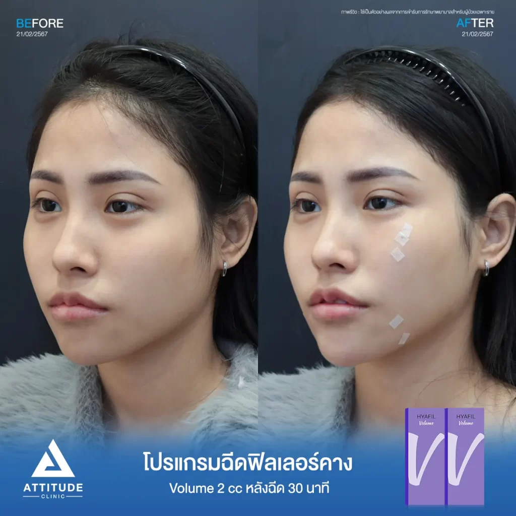 รีวิวโปรแกรมฉีดฟิลเลอร์คางคุณพิม รุ่น Volume จำนวน 2 cc หลังฉีด 30 นาที เติมเต็มคาง ปรับรูปคางให้เรียวสวย เพิ่มมิติใบหน้าให้ได้สัดส่วนมากขึ้นที่ Attitude Clinic