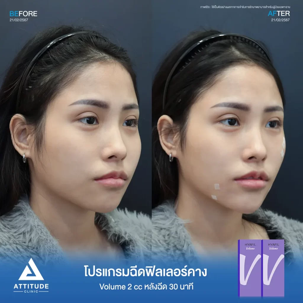 รีวิวโปรแกรมฉีดฟิลเลอร์คางคุณพิม รุ่น Volume จำนวน 2 cc หลังฉีด 30 นาที เติมเต็มคาง ปรับรูปคางให้เรียวสวย เพิ่มมิติใบหน้าให้ได้สัดส่วนมากขึ้นที่ Attitude Clinic