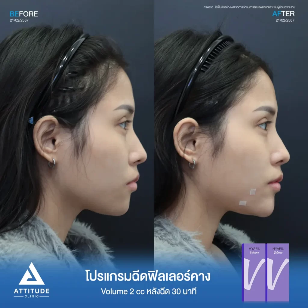 รีวิวโปรแกรมฉีดฟิลเลอร์คางคุณพิม รุ่น Volume จำนวน 2 cc หลังฉีด 30 นาที เติมเต็มคาง ปรับรูปคางให้เรียวสวย เพิ่มมิติใบหน้าให้ได้สัดส่วนมากขึ้นที่ Attitude Clinic