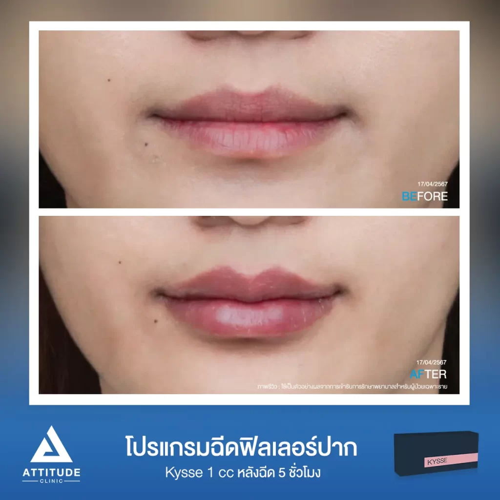 รีวิวโปรแกรมฉีดฟิลเลอร์ปากคุณกมลวรรณรุ่น KYSSE จำนวน 1 cc หลังฉีด 2 ชั่วโมง เติมเต็มร่องริมฝีปาก ให้ปากอวบอิ่ม ปรับทรงปาก มีมิติได้ทรงสวย ปากชุ่มชื้น ดูสุขภาพดีที่ Attitude Clinic