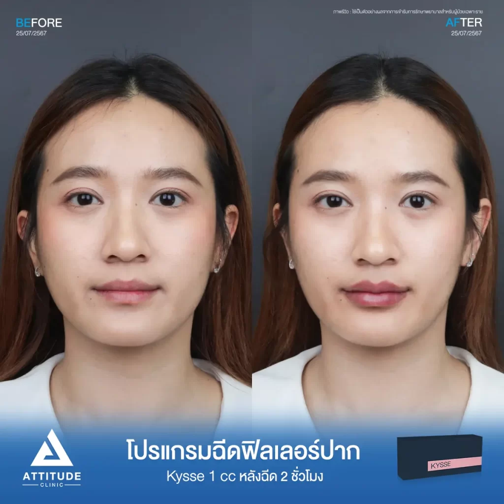 รีวิวโปรแกรมฉีดฟิลเลอร์ปากคุณกมลวรรณรุ่น KYSSE จำนวน 1 cc หลังฉีด 2 ชั่วโมง เติมเต็มร่องริมฝีปาก ให้ปากอวบอิ่ม ปรับทรงปาก มีมิติได้ทรงสวย ปากชุ่มชื้น ดูสุขภาพดีที่ Attitude Clinic