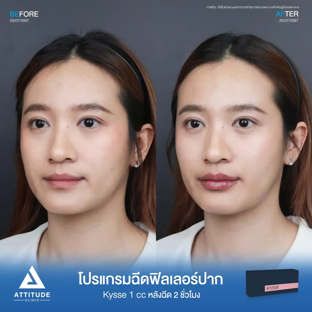 รีวิวโปรแกรมฉีดฟิลเลอร์ปากคุณกมลวรรณรุ่น KYSSE จำนวน 1 cc หลังฉีด 2 ชั่วโมง เติมเต็มร่องริมฝีปาก ให้ปากอวบอิ่ม ปรับทรงปาก มีมิติได้ทรงสวย ปากชุ่มชื้น ดูสุขภาพดีที่ Attitude Clinic