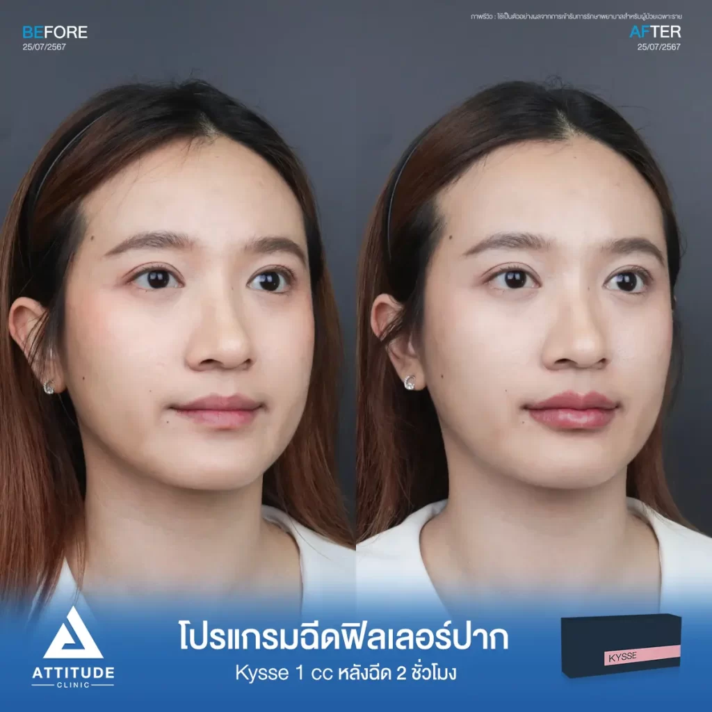 รีวิวโปรแกรมฉีดฟิลเลอร์ปากคุณกมลวรรณรุ่น KYSSE จำนวน 1 cc หลังฉีด 2 ชั่วโมง เติมเต็มร่องริมฝีปาก ให้ปากอวบอิ่ม ปรับทรงปาก มีมิติได้ทรงสวย ปากชุ่มชื้น ดูสุขภาพดีที่ Attitude Clinic