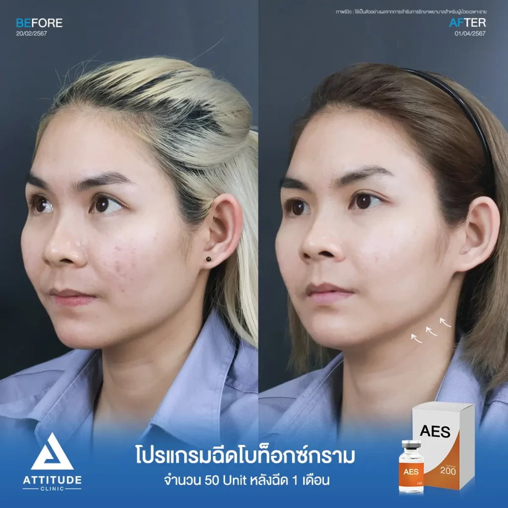 รีวิวโปรแกรมฉีดโบท็อกซ์ลดขนาดกล้ามเนื้อกรามคุณทิพย์ จำนวน 50 Unit หลังฉีด 1 เดือน ปรับรูปหน้าให้เรียวได้รูป เพิ่มมิติให้หน้าได้สัดส่วนมากขึ้นที่ Attitude Clinic