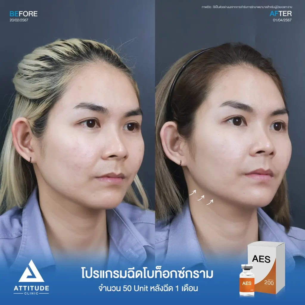 รีวิวโปรแกรมฉีดโบท็อกซ์ลดขนาดกล้ามเนื้อกรามคุณทิพย์ จำนวน 50 Unit หลังฉีด 1 เดือน ปรับรูปหน้าให้เรียวได้รูป เพิ่มมิติให้หน้าได้สัดส่วนมากขึ้นที่ Attitude Clinic