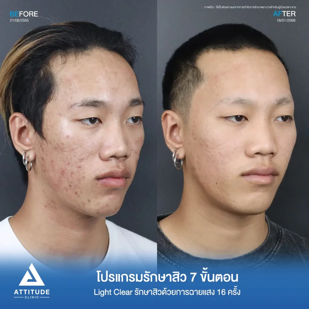 รีวิวรักษาสิวคุณเทม ด้วยการฉายแสง โปรแกรมรักษาสิว Light Clear 7 ขั้นตอน จำนวน 16 ครั้ง รักษาสิวอุดตัน สิวอักเสบ รอยแดงทั่วใบหน้าโดยเฉพาะบริเวณแก้ม 2 ข้างที่ Attitude Clinic