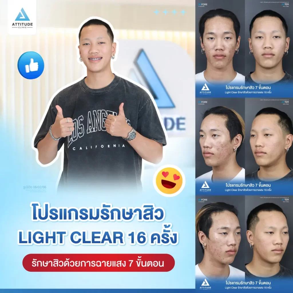 รีวิวรักษาสิวคุณเทม ด้วยการฉายแสง โปรแกรมรักษาสิว Light Clear 7 ขั้นตอน จำนวน 16 ครั้ง รักษาสิวอุดตัน สิวอักเสบ รอยแดงทั่วใบหน้าโดยเฉพาะบริเวณแก้ม 2 ข้างที่ Attitude Clinic