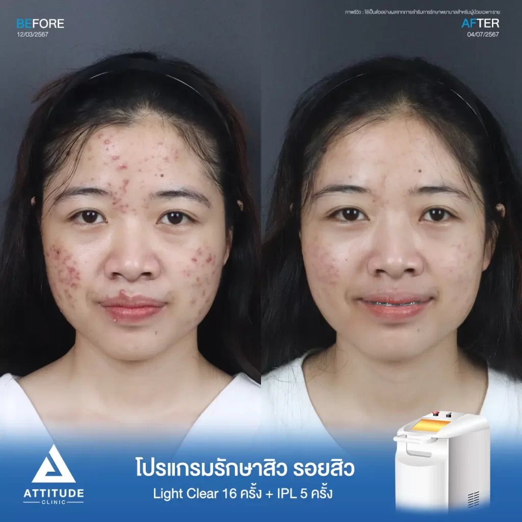 รีวิวรักษาสิวน้องมายด์ ด้วยการฉายแสง โปรแกรมรักษาสิว Light Clear 7 ขั้นตอน จำนวน 16 ครั้ง และโปรแกรม IPL หน้าใส จำนวน 5 ครั้ง รักษาสิวฮอร์โมน สิวอักเสบหัวหนอง สิวอุดตัน และรอยแดงสิวทั่วใบหน้าที่ Attitude Clinic