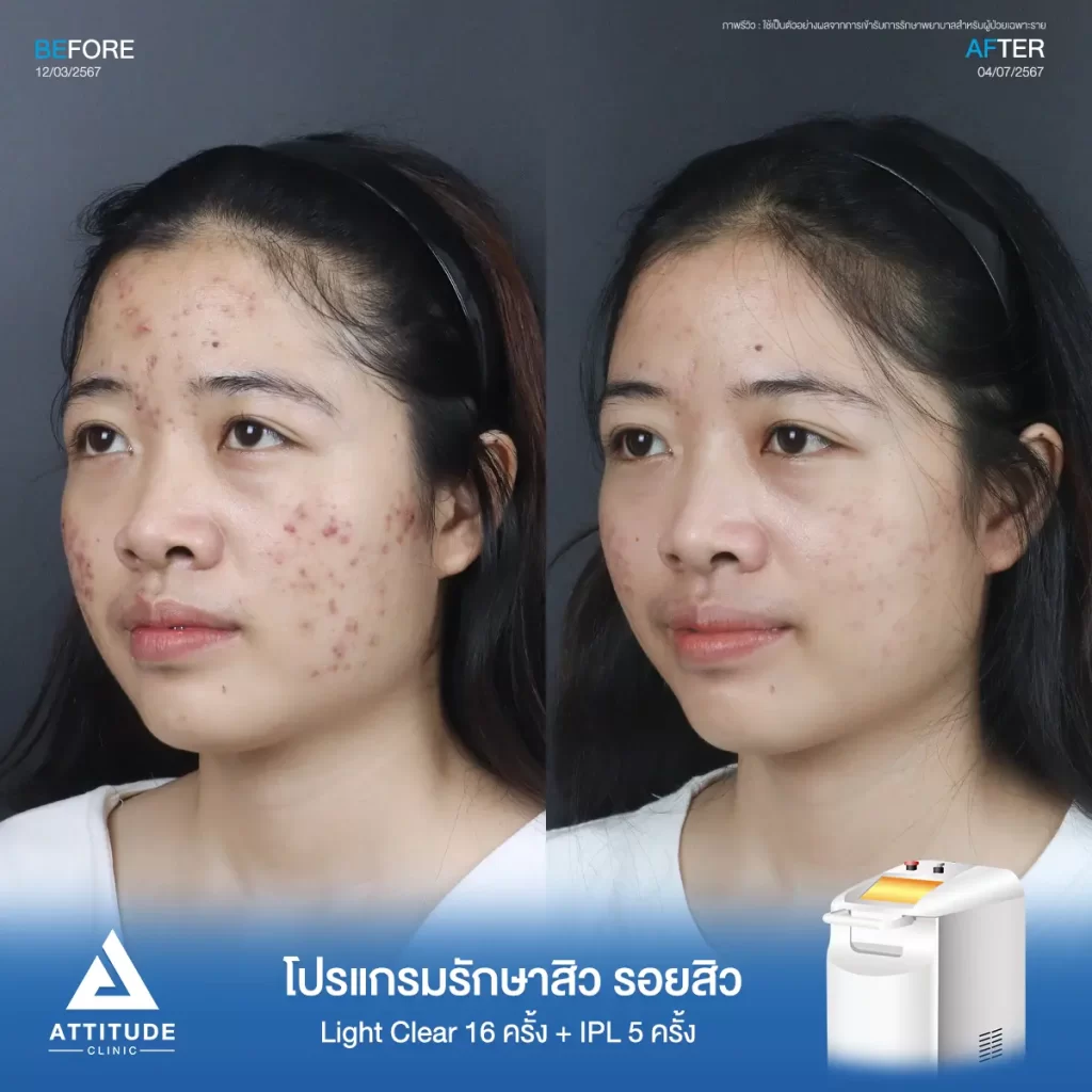 รีวิวรักษาสิวน้องมายด์ ด้วยการฉายแสง โปรแกรมรักษาสิว Light Clear 7 ขั้นตอน จำนวน 16 ครั้ง และโปรแกรม IPL หน้าใส จำนวน 5 ครั้ง รักษาสิวฮอร์โมน สิวอักเสบหัวหนอง สิวอุดตัน และรอยแดงสิวทั่วใบหน้าที่ Attitude Clinic