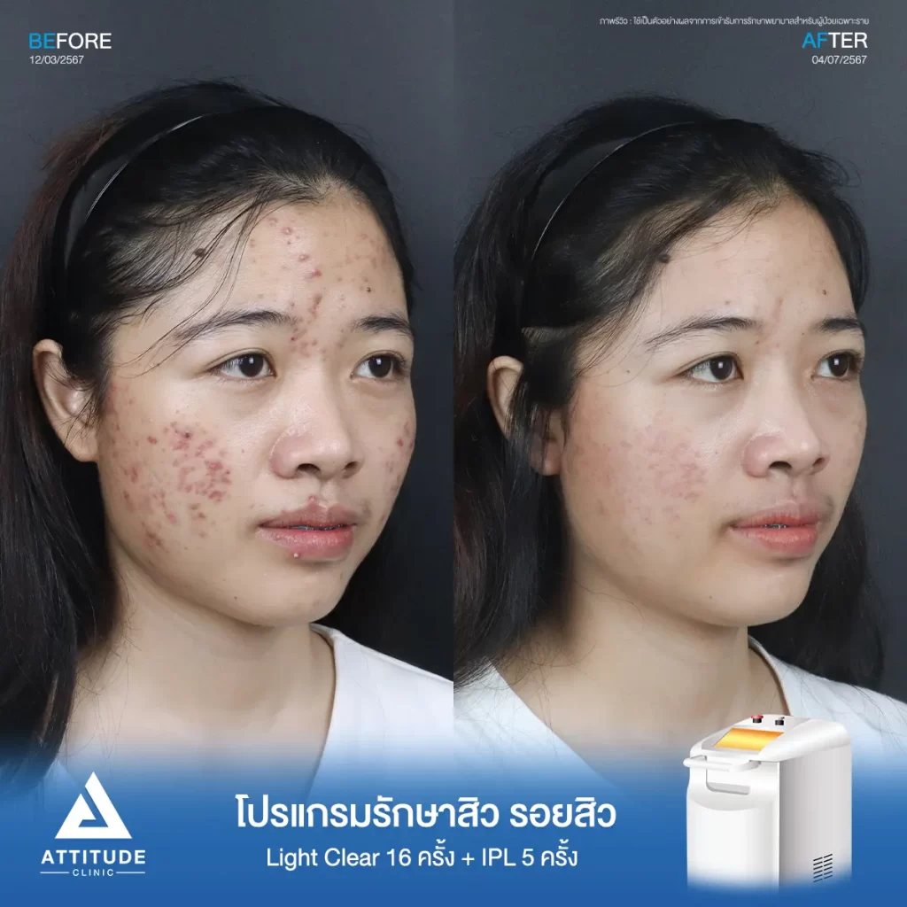 รีวิวรักษาสิวน้องมายด์ ด้วยการฉายแสง โปรแกรมรักษาสิว Light Clear 7 ขั้นตอน จำนวน 16 ครั้ง และโปรแกรม IPL หน้าใส จำนวน 5 ครั้ง รักษาสิวฮอร์โมน สิวอักเสบหัวหนอง สิวอุดตัน และรอยแดงสิวทั่วใบหน้าที่ Attitude Clinic