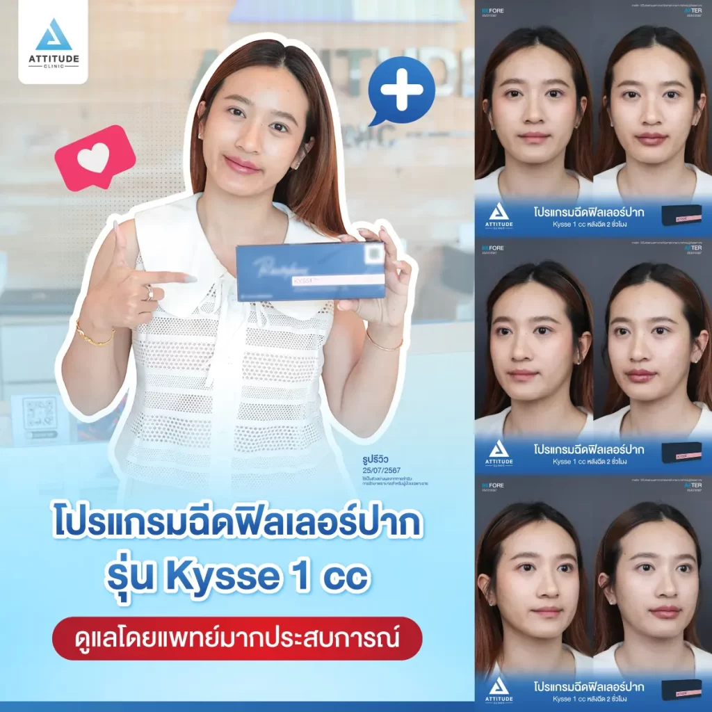 รีวิวโปรแกรมฉีดฟิลเลอร์ปากคุณกมลวรรณรุ่น KYSSE จำนวน 1 cc หลังฉีด 2 ชั่วโมง เติมเต็มร่องริมฝีปาก ให้ปากอวบอิ่ม ปรับทรงปาก มีมิติได้ทรงสวย ปากชุ่มชื้น ดูสุขภาพดีที่ Attitude Clinic