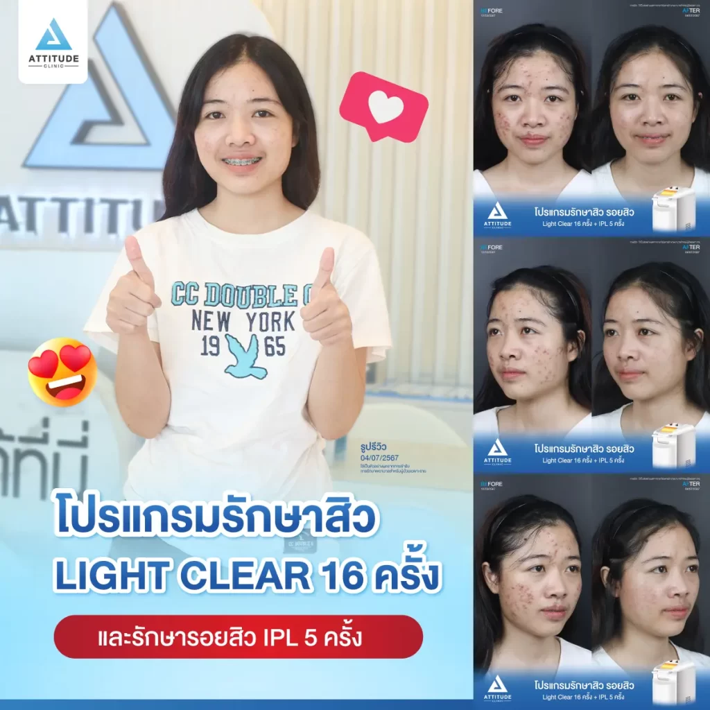 รีวิวรักษาสิวน้องมายด์ ด้วยการฉายแสง โปรแกรมรักษาสิว Light Clear 7 ขั้นตอน จำนวน 16 ครั้ง และโปรแกรม IPL หน้าใส จำนวน 5 ครั้ง รักษาสิวฮอร์โมน สิวอักเสบหัวหนอง สิวอุดตัน และรอยแดงสิวทั่วใบหน้าที่ Attitude Clinic