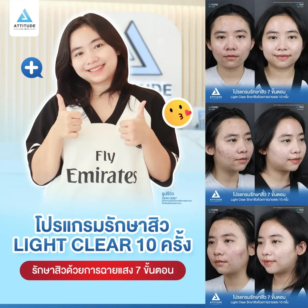 รีวิวรักษาสิวคุณไอซ์ ด้วยการฉายแสง โปรแกรมรักษาสิว Light Clear 7 ขั้นตอน จำนวน 10 ครั้ง รักษาสิวอักเสบ สิวอุดตัน และรอยแดงสิวทั่วใบหน้าที่ Attitude Clinic