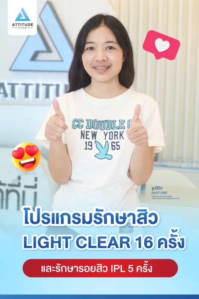 รีวิวรักษาสิวน้องมายด์ ด้วยการฉายแสง โปรแกรมรักษาสิว Light Clear 7 ขั้นตอน จำนวน 16 ครั้ง และโปรแกรม IPL หน้าใส จำนวน 5 ครั้ง รักษาสิวฮอร์โมน สิวอักเสบหัวหนอง สิวอุดตัน และรอยแดงสิวทั่วใบหน้าที่ Attitude Clinic