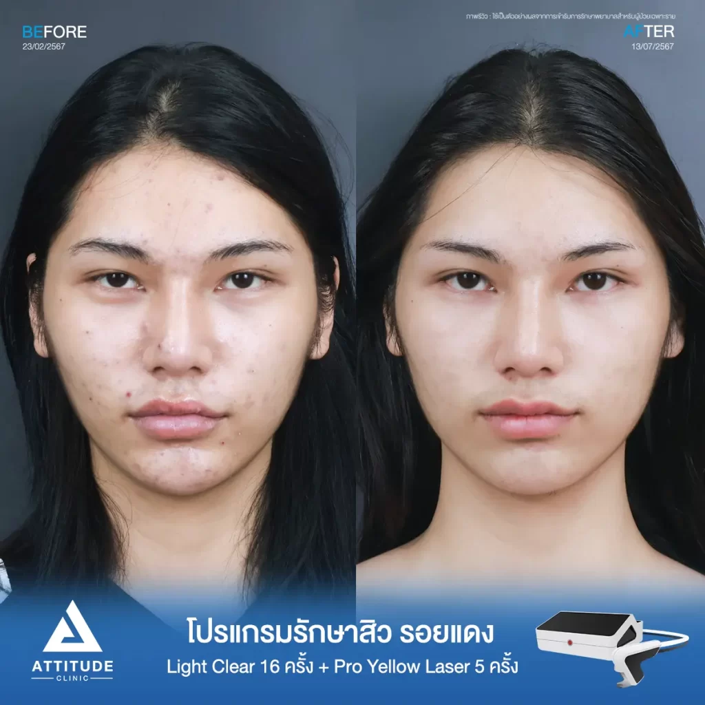 รีวิวรักษาสิวคุณจูลี่ ด้วยการฉายแสง โปรแกรมรักษาสิว Light Clear 7 ขั้นตอน จำนวน 16 ครั้ง ต่อด้วย Pro Yellow Laser รักษารอยแดง จำนวน 5 ครั้ง รักษาสิวอุดตัน สิวอักเสบเม็ดใหญ่ รอยแดงจากสิวทั่วใบหน้าที่ Attitude Clinic