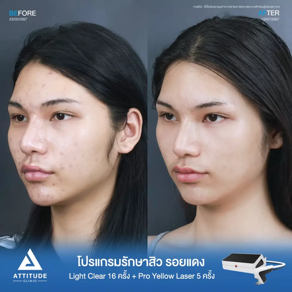 รีวิวรักษาสิวคุณจูลี่ ด้วยการฉายแสง โปรแกรมรักษาสิว Light Clear 7 ขั้นตอน จำนวน 16 ครั้ง ต่อด้วย Pro Yellow Laser รักษารอยแดง จำนวน 5 ครั้ง รักษาสิวอุดตัน สิวอักเสบเม็ดใหญ่ รอยแดงจากสิวทั่วใบหน้าที่ Attitude Clinic