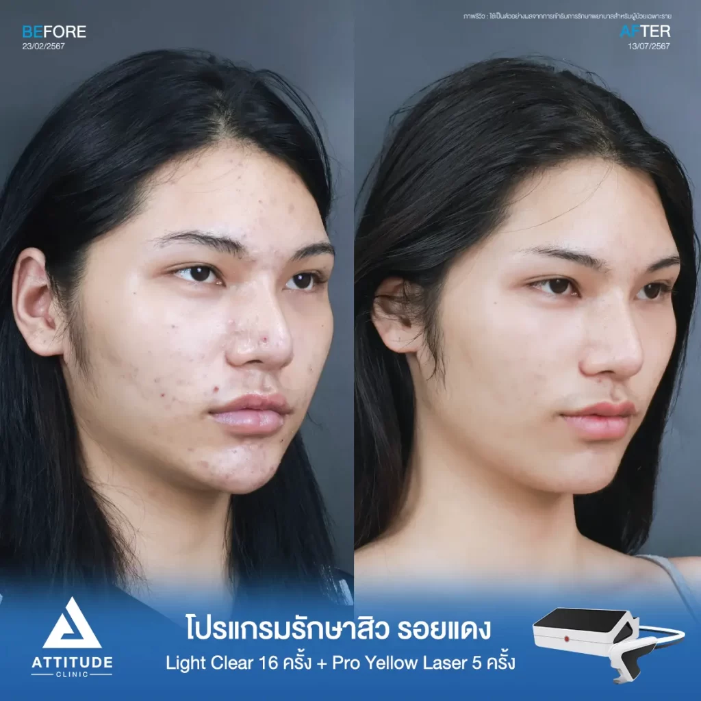 รีวิวรักษาสิวคุณจูลี่ ด้วยการฉายแสง โปรแกรมรักษาสิว Light Clear 7 ขั้นตอน จำนวน 16 ครั้ง ต่อด้วย Pro Yellow Laser รักษารอยแดง จำนวน 5 ครั้ง รักษาสิวอุดตัน สิวอักเสบเม็ดใหญ่ รอยแดงจากสิวทั่วใบหน้าที่ Attitude Clinic