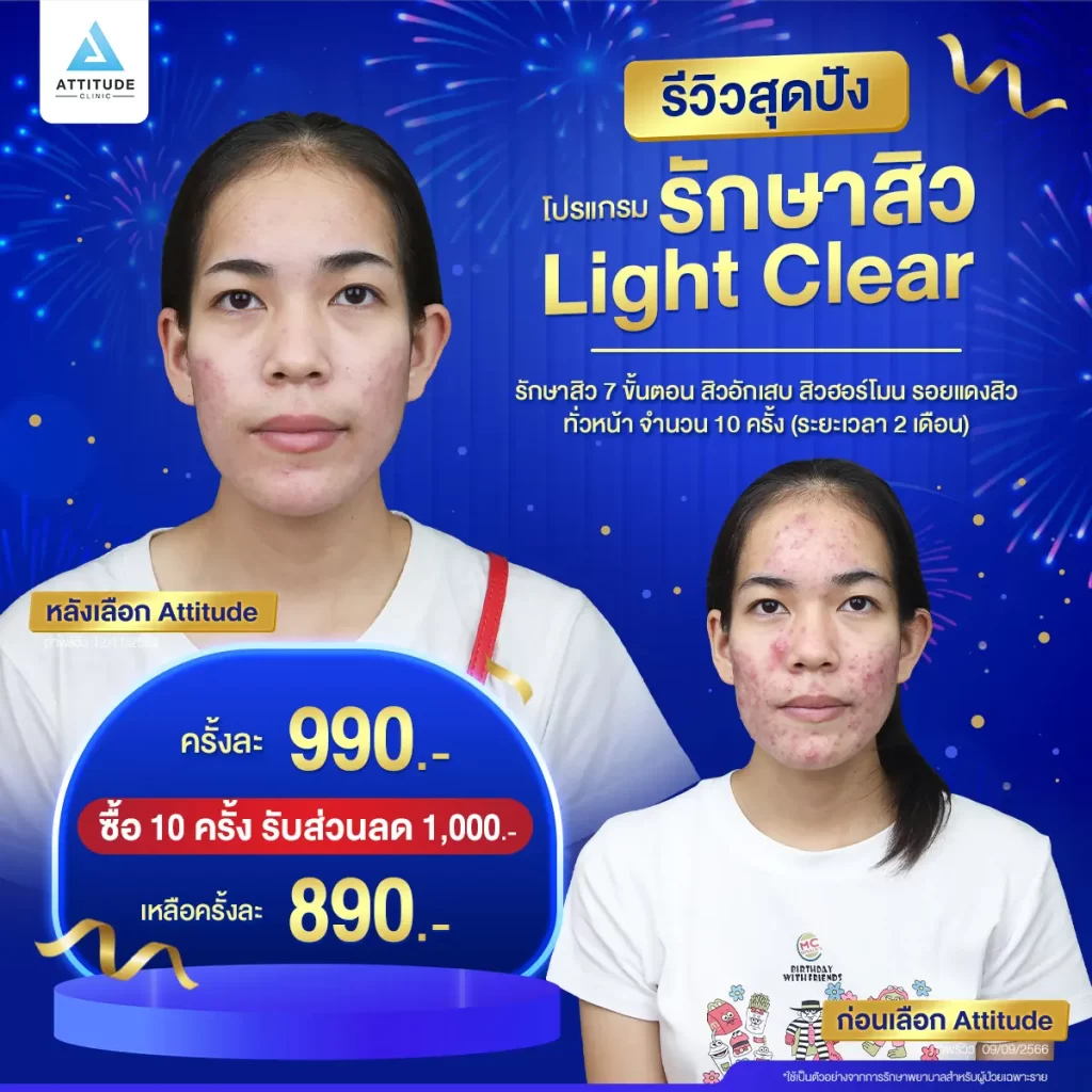 รวมรีวิวรักษาสิวสุดปัง เป็นสิวหนักแค่ไหนก็หายได้ถ้ารักษาถูกวิธี