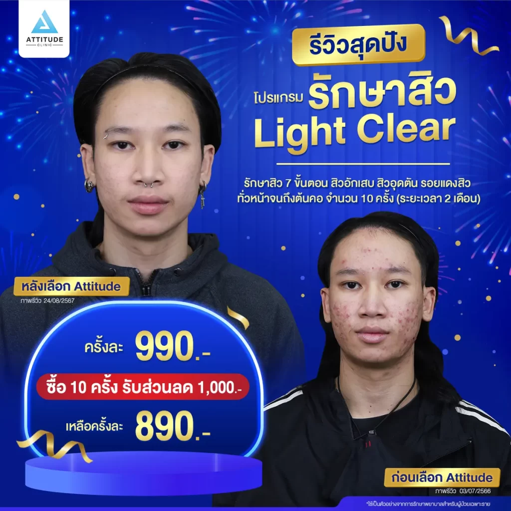 รวมรีวิวรักษาสิวสุดปัง เป็นสิวหนักแค่ไหนก็หายได้ถ้ารักษาถูกวิธี