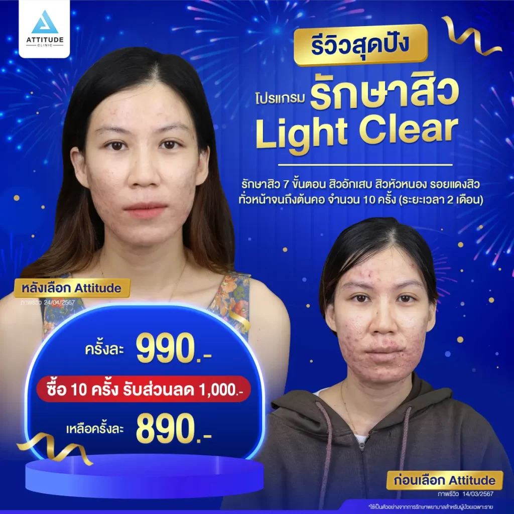 รวมรีวิวรักษาสิวสุดปัง เป็นสิวหนักแค่ไหนก็หายได้ถ้ารักษาถูกวิธี