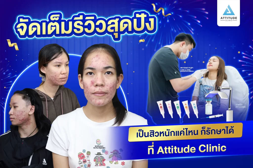 รวมรีวิวรักษาสิวสุดปัง เป็นสิวหนักแค่ไหนก็หายได้ถ้ารักษาถูกวิธี