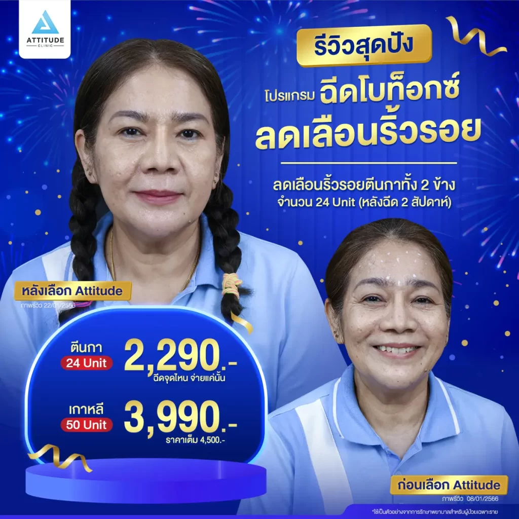 รวมรีวิวโปรแกรมฉีดโบท็อกซ์สุดปัง หน้าเรียว หน้าตึงแบบนี้ต้องฉีดโปรแกรมโบท็อกซ์กี่ยูนิต ??