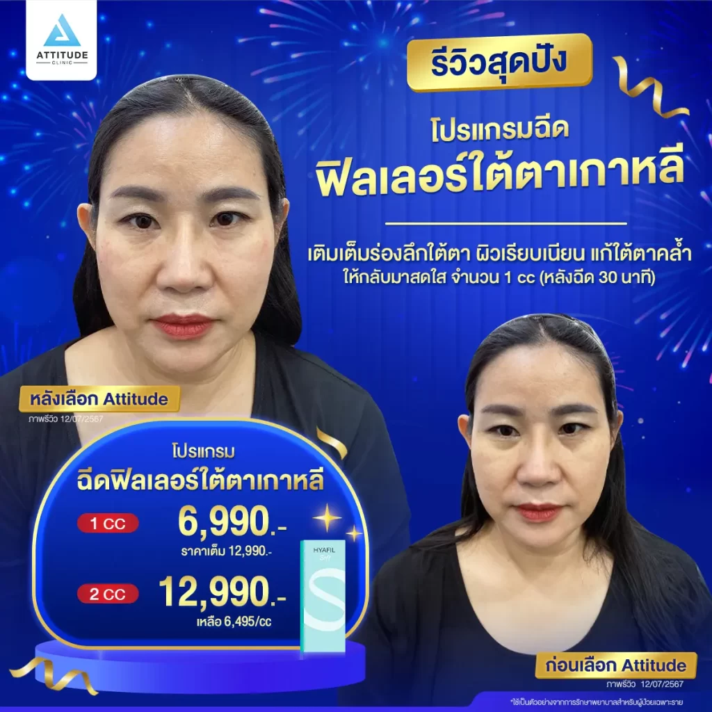 รวมรีวิวโปรแกรมฉีดฟิลเลอร์ใต้ตาสุดปัง ลบตาแพนด้า เบรคหน้าโทรม แค่ 1 cc จะช่วยได้จริงมั้ย