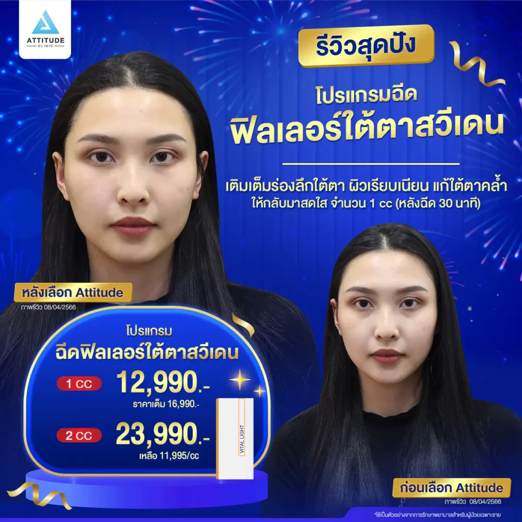 รวมรีวิวโปรแกรมฉีดฟิลเลอร์ใต้ตาสุดปัง ลบตาแพนด้า เบรคหน้าโทรม แค่ 1 cc จะช่วยได้จริงมั้ย