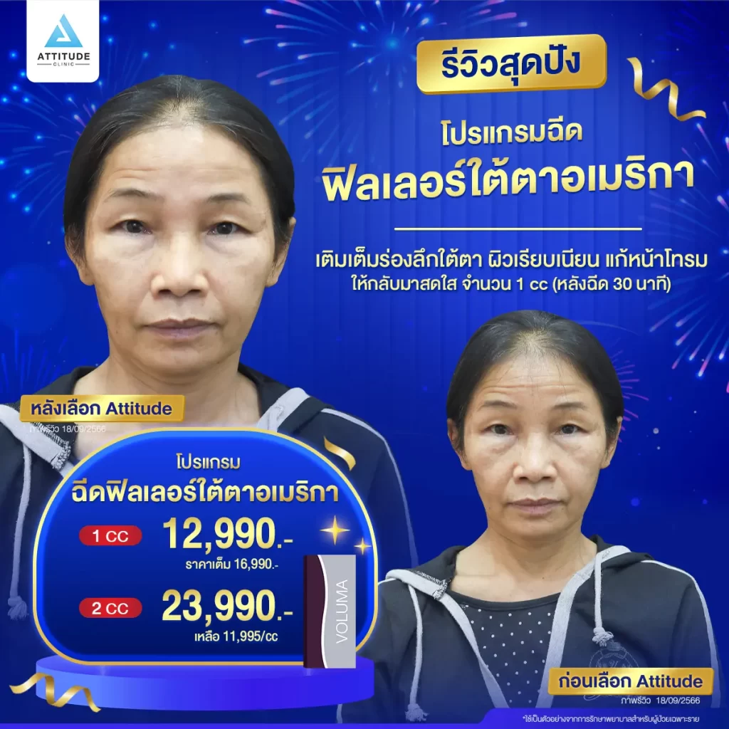 รวมรีวิวโปรแกรมฉีดฟิลเลอร์ใต้ตาสุดปัง ลบตาแพนด้า เบรคหน้าโทรม แค่ 1 cc จะช่วยได้จริงมั้ย