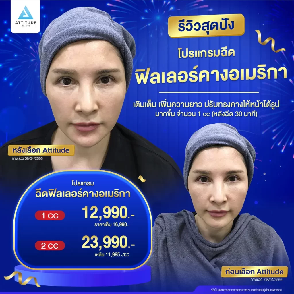 รวมรีวิวโปรแกรมฉีดฟิลเลอร์คางสุดปัง หมดปัญหากวนใจ เลิกสงสัยทำไมหน้าไม่เรียว