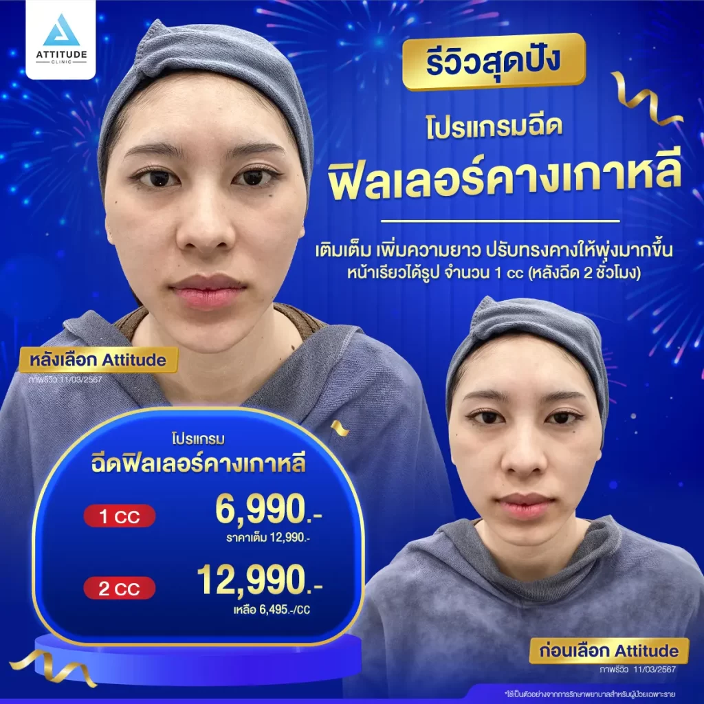 รวมรีวิวโปรแกรมฉีดฟิลเลอร์คางสุดปัง หมดปัญหากวนใจ เลิกสงสัยทำไมหน้าไม่เรียว