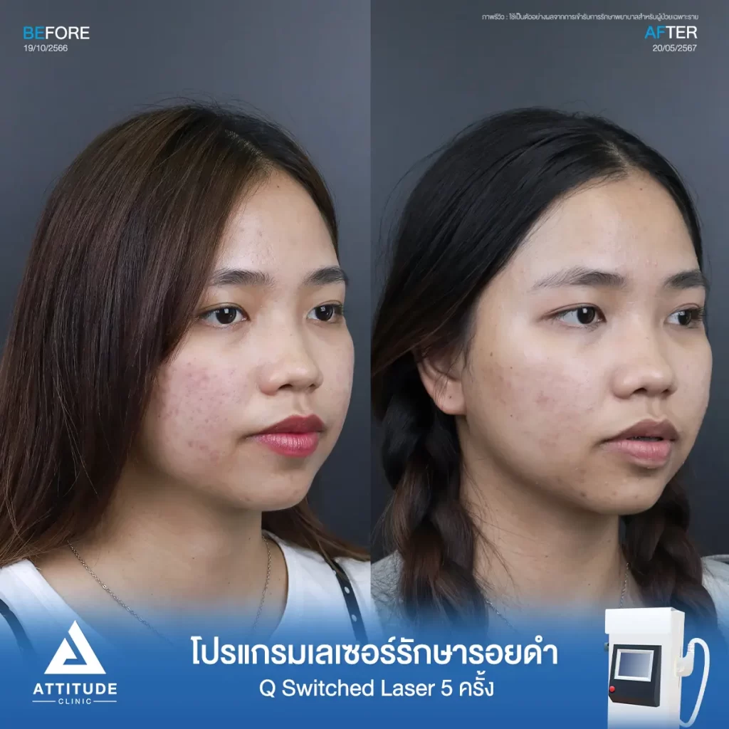 รีวิวรักษารอยดำคุณระพีพร ด้วยโปรแกรม Q Switched Laser จำนวน 5 ครั้ง รักษารอยดำจากสิว และจุดด่างดำทั่วใบหน้าโดยเฉพาะบริเวณแก้ม 2 ข้างที่ Attitude Clinic