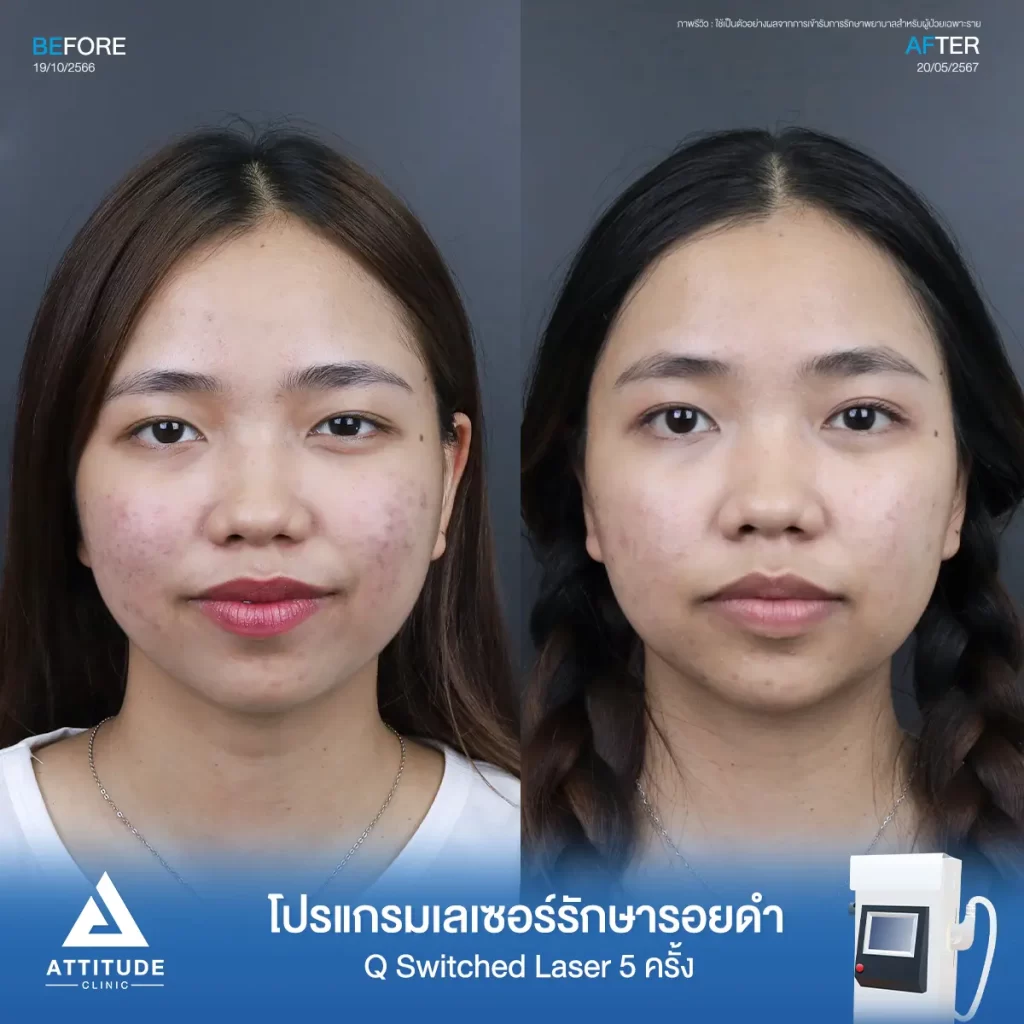 รีวิวรักษารอยดำคุณระพีพร ด้วยโปรแกรม Q Switched Laser จำนวน 5 ครั้ง รักษารอยดำจากสิว และจุดด่างดำทั่วใบหน้าโดยเฉพาะบริเวณแก้ม 2 ข้างที่ 𝗔𝘁𝘁𝗶𝘁𝘂𝗱𝗲 𝗖𝗹𝗶𝗻𝗶𝗰