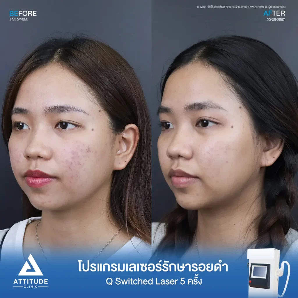 รีวิวรักษารอยดำคุณระพีพร ด้วยโปรแกรม Q Switched Laser จำนวน 5 ครั้ง รักษารอยดำจากสิว และจุดด่างดำทั่วใบหน้าโดยเฉพาะบริเวณแก้ม 2 ข้างที่ Attitude Clinic