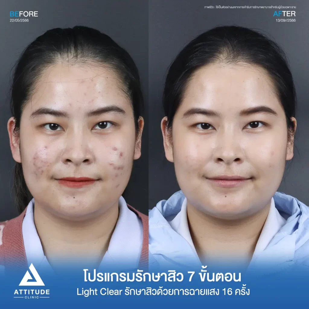 รีวิวรักษาสิวคุณฝน ด้วยการฉายแสง โปรแกรมรักษาสิว Light Clear 7 ขั้นตอน จำนวน 10 ครั้ง รักษาสิวอุดตัน สิวผด สิวอักเสบทั่วใบหน้า โดยเฉพาะบริเวณแก้ม 2 ข้างที่ Attitude Clinic