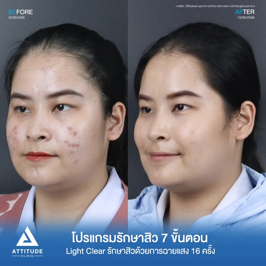 รีวิวรักษาสิวคุณฝน ด้วยการฉายแสง โปรแกรมรักษาสิว Light Clear 7 ขั้นตอน จำนวน 10 ครั้ง รักษาสิวอุดตัน สิวผด สิวอักเสบทั่วใบหน้า โดยเฉพาะบริเวณแก้ม 2 ข้างที่ Attitude Clinic