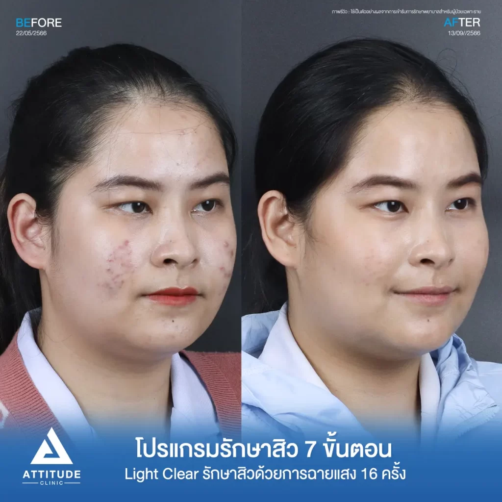 รีวิวรักษาสิวคุณฝน ด้วยการฉายแสง โปรแกรมรักษาสิว Light Clear 7 ขั้นตอน จำนวน 10 ครั้ง รักษาสิวอุดตัน สิวผด สิวอักเสบทั่วใบหน้า โดยเฉพาะบริเวณแก้ม 2 ข้างที่ Attitude Clinic