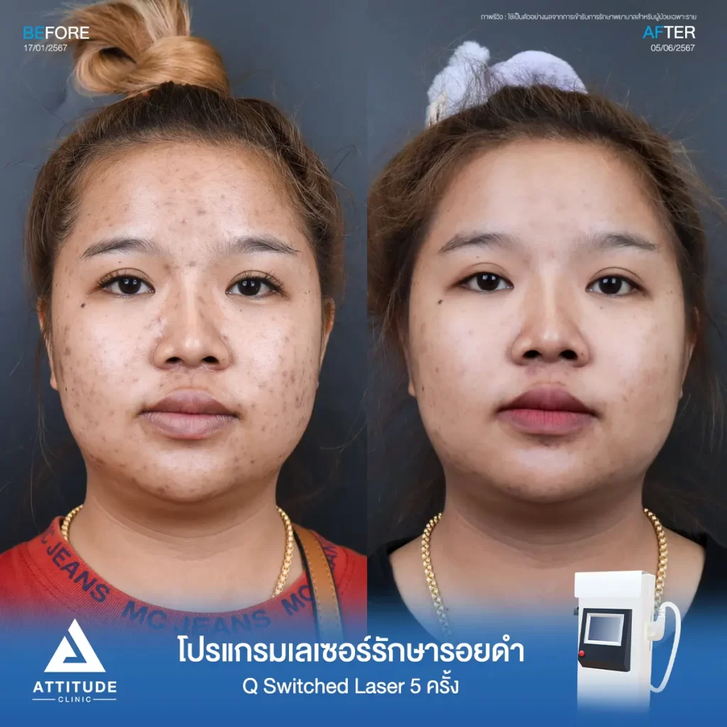 รีวิวรักษารอยดำคุณนฤนาถ ด้วยโปรแกรม Q Switched Laser จำนวน 5 ครั้ง รักษารอยดำจากสิว และจุดด่างดำทั่วใบหน้าที่ Attitude Clinic