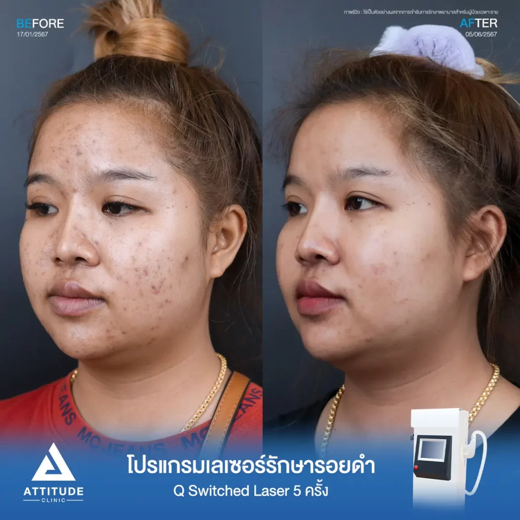 รีวิวรักษารอยดำคุณนฤนาถ ด้วยโปรแกรม Q Switched Laser จำนวน 5 ครั้ง รักษารอยดำจากสิว และจุดด่างดำทั่วใบหน้าที่ Attitude Clinic