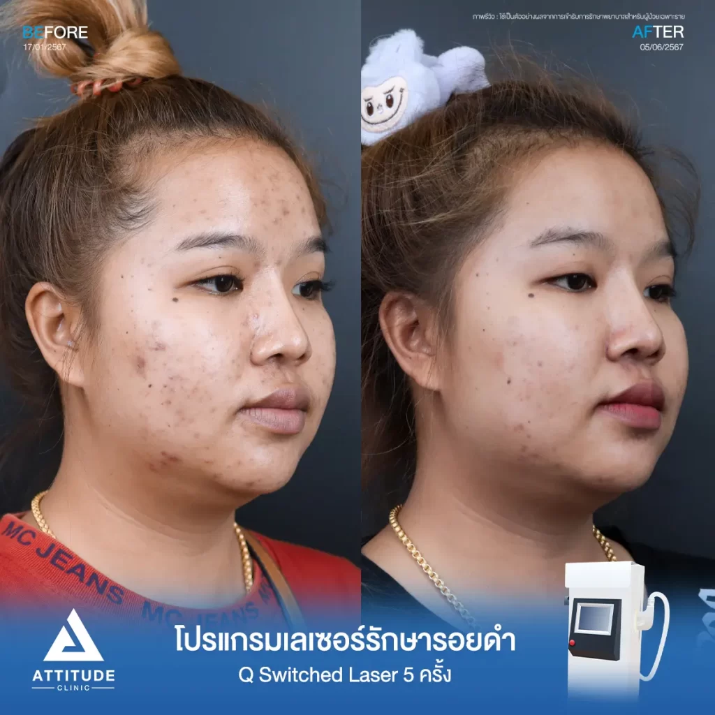 รีวิวรักษารอยดำคุณนฤนาถ ด้วยโปรแกรม Q Switched Laser จำนวน 5 ครั้ง รักษารอยดำจากสิว และจุดด่างดำทั่วใบหน้าที่ Attitude Clinic