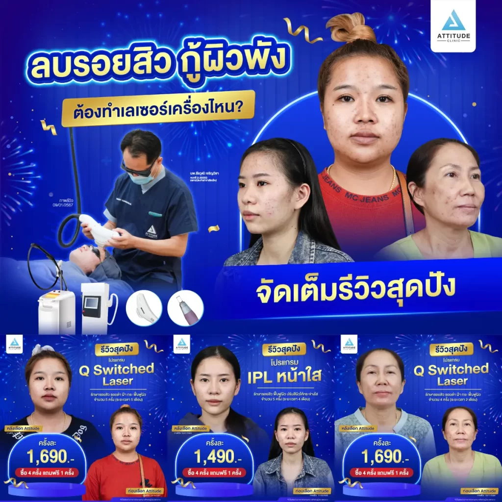 รวมรีวิวรักษารอยสิวสุดปัง อยากลบรอยสิว กู้ผิวพัง เลือกทำเลเซอร์เครื่องไหนดี !?