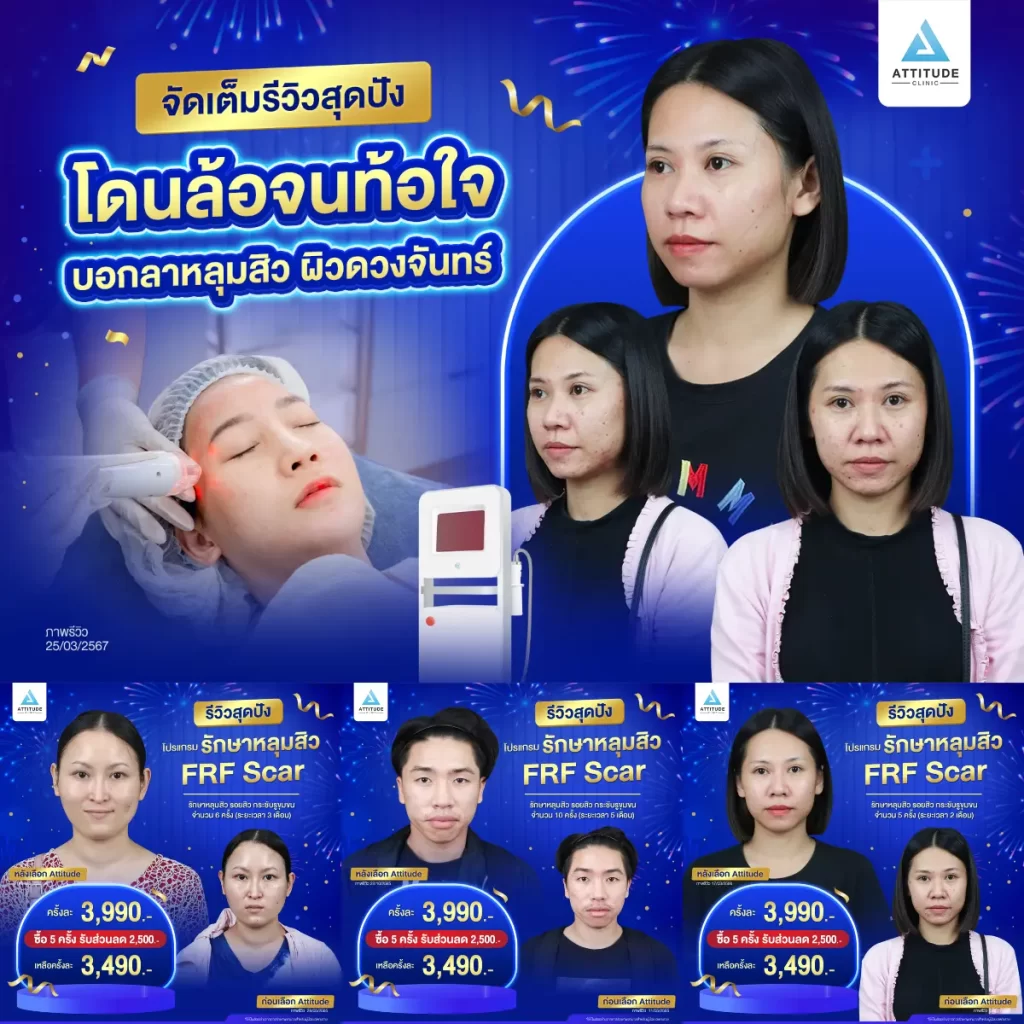 รวมรีวิวรักษาหลุมสิวสุดปัง บอกลาหลุมสิว ผิวดวงจันทร์ที่คอยกวนใจ