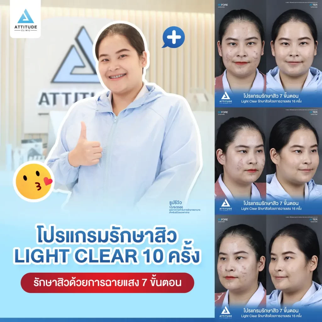 รีวิวรักษาสิวคุณฝน ด้วยการฉายแสง โปรแกรมรักษาสิว Light Clear 7 ขั้นตอน จำนวน 10 ครั้ง รักษาสิวอุดตัน สิวผด สิวอักเสบทั่วใบหน้า โดยเฉพาะบริเวณแก้ม 2 ข้างที่ Attitude Clinic