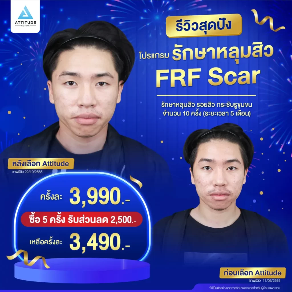 รวมรีวิวรักษาหลุมสิวสุดปัง บอกลาหลุมสิว ผิวดวงจันทร์ที่คอยกวนใจ